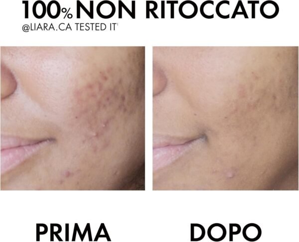 Vichy Normaderm Trattamento Anti-Imperfezioni a Doppia Azione per Pelli Grasse Effetto Correttivo e Idratante con Acido Salicilico, Acido Ialuronico e Frazioni Probiotiche, 50 ml